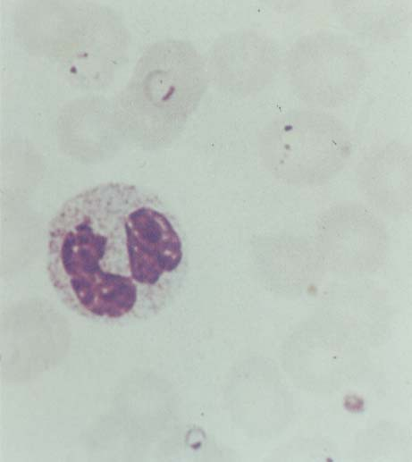 5. Thin blood film (Giemsa): - Plasmodium falciparum Plasmodium