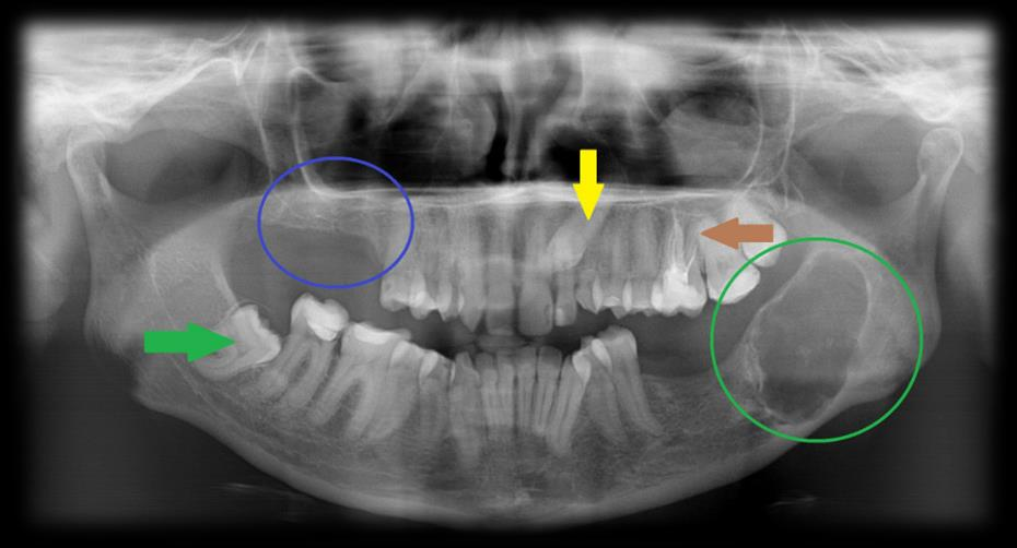 Anyag és módszer caries profunda inkomplett gyökértömés abscessus granuloma cysta periodontitis periimplantitis