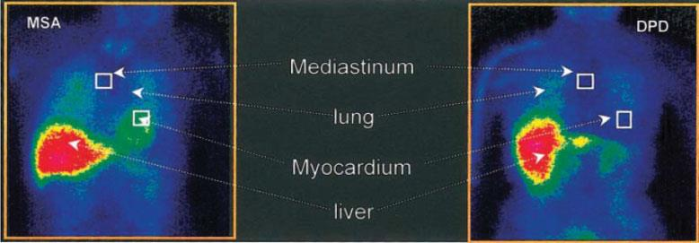 MIBG (metaiodobenzylguanidine) szcintigráfia MIBG: Heart MIBG scintigraphy.123i-mibg scintigraphy.