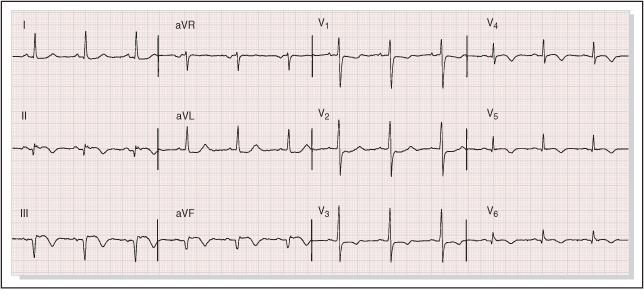 Diagnosis EKG - STEMI akut