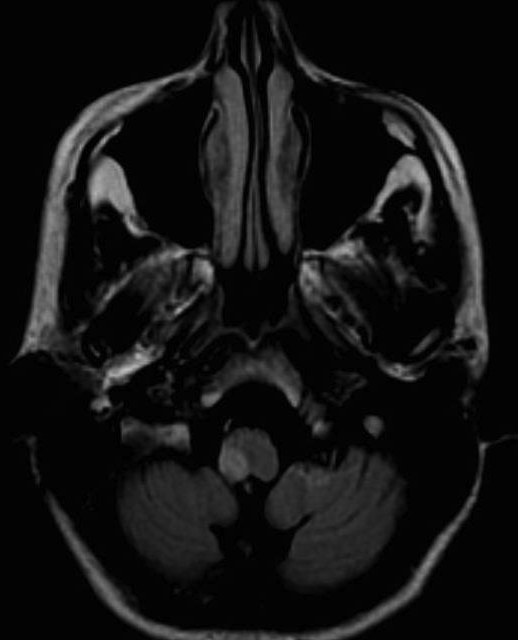 Vertebrobasilaris területi stroke akut kezdetű, folytonos szédülés, napokon át tartó VB TIA: <24 óra, gyakran visszatérő, de hamar követi stroke ~50%: vesztibuláris tünetek + egyéb