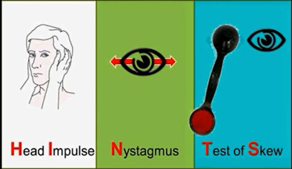 Akut vesztibuláris szindróma HINTS+ paradigma: centrális eredet (VB stroke):!