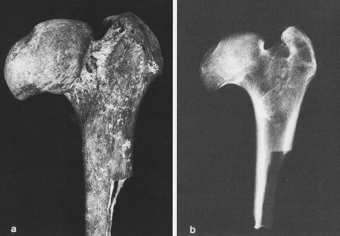 2. a b ábra A Legg Calvè Perthes kóros femur