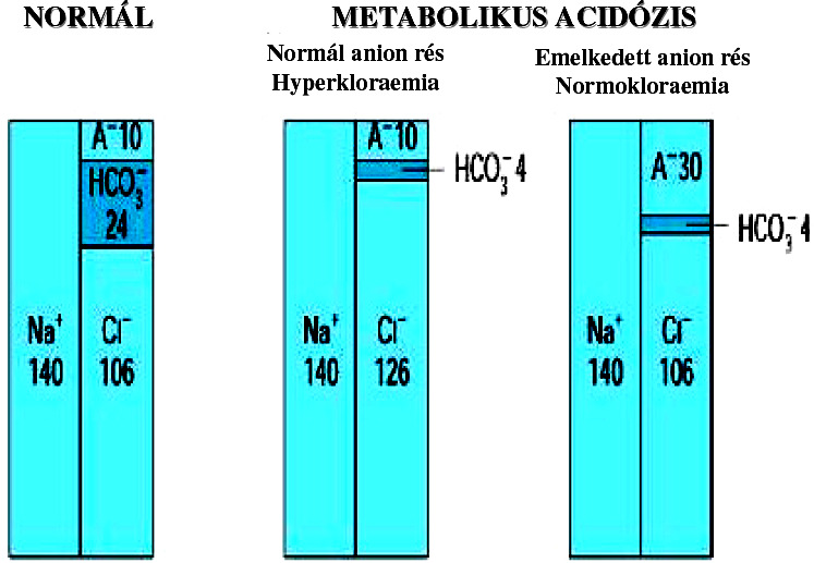 A./ Emelkedett anion réssel járó, normoklorémiás, metabolikus acidózis: Okai: sav többlettel járó állapotok 1.