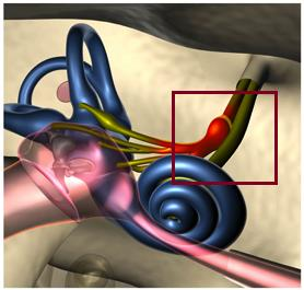 Neuritis vestibularis feltételezett patomechanizmus: a vesztibuláris ganglionban perzisztáló HSV-1 vírus reaktivációja akut féloldali n.