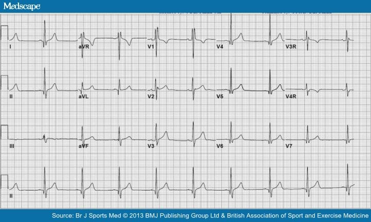 Sportolók normális és kóros ekg jelei Zámolyi Károly - PDF Ingyenes letöltés