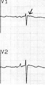 ARVD - EKG QRS>110 ms V1 epsilon hullám V1-2 (30%) T inverzio V1-2-3 (50-70%)