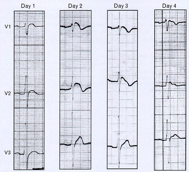 SCN5A+ betegen Brugada