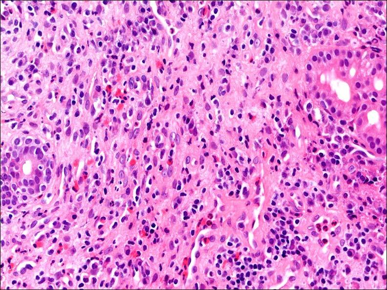 Chronicus sinusitis Súlyos mononuclearis