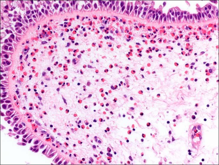 Nasal polyps inflammatory pseudopolyps Edematous