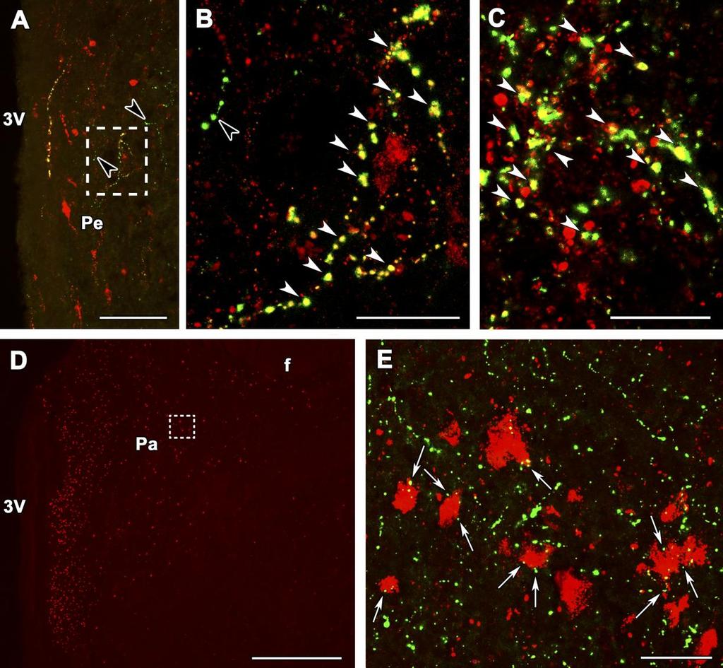 18. ábra PTH2R immunreaktív rostok viszonya somatostatin és CRH immunreaktiv rostokhoz és sejtekhez humán hypothalamus paraventricularis, periventricularis magjaiban és az eminentia medianaban.