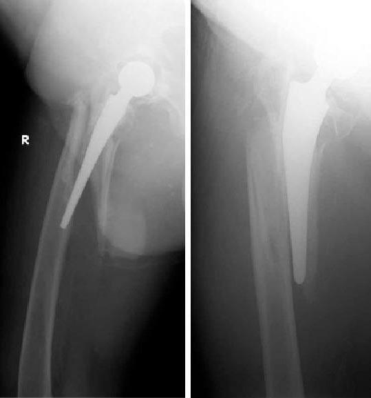 ábra Reef-szár beültetés és cerclage osteosynthesis után két évvel MEGBESZÉLÉS A femurra lokalizálódó, az AAOS I.