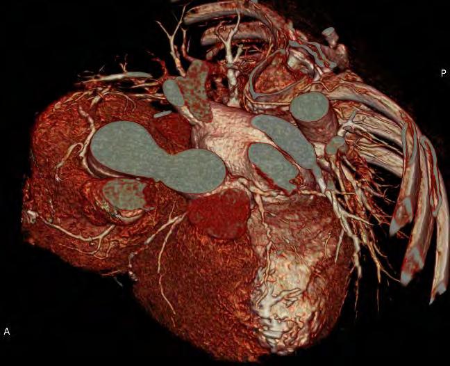 arrhythmia, HR: 45 125