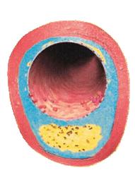 összefüggés Stenosis mértéke 0% 50% 100% Plaque