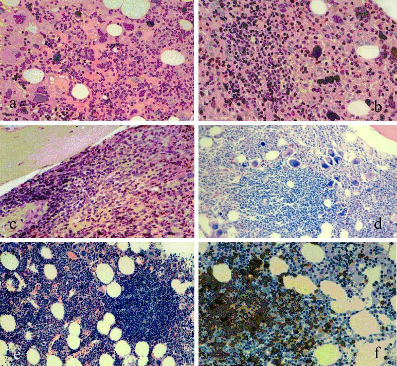 3.3.2 3.3.2.5. ábra Különböző mennyiségű és topografikus eloszlást mutató lymphocytás infiltrátum MPB betegek csontvelőiben.