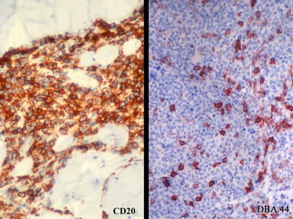 ábra A crista biopsia paraffinos blokkjából extrahált DNS mintából (S) PCR eljárással kimutatott monoklonális IgH
