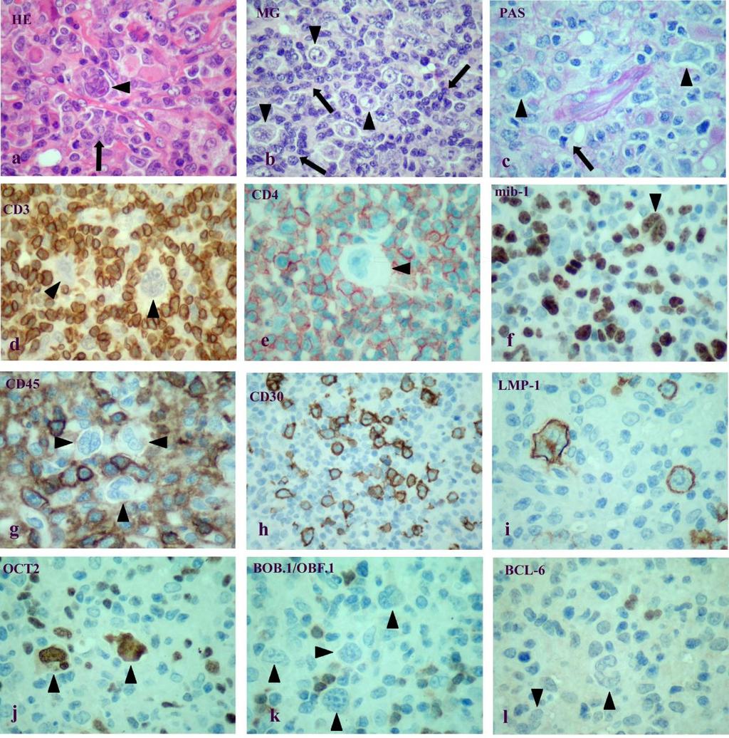 3.4 3.4.1. ábra A három PTCL-ban észlelt morfológiai, immunhistologiai és in situ hibridizációs leletek.
