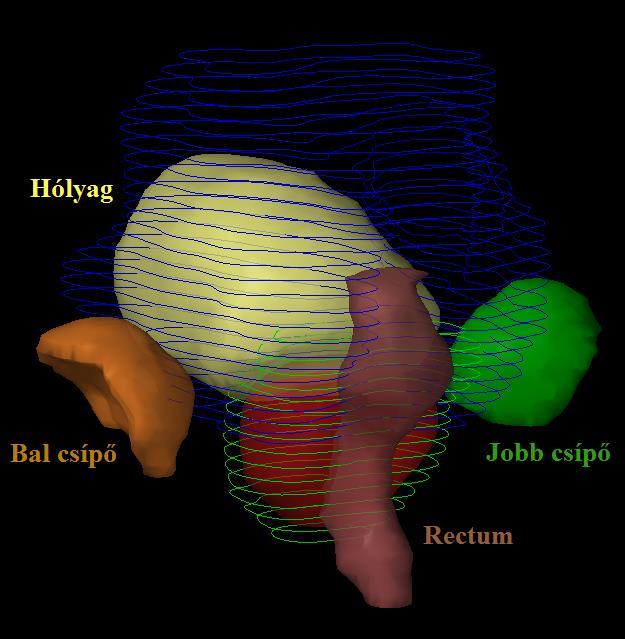 3. ábra Védendő szervek: rectum, hólyag, bal és jobb csípő Hólyag tekintetében 65 Gy-nél nagyobb dózis leadása esetén 5 évvel a besugárzást követően 3% eséllyel fordulhat elő inkontinencia illetve