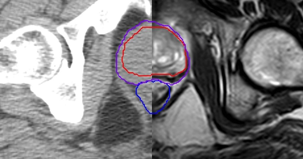 2.7. ábra. CT-MR fúzió axiális szeleten. Pirossal a prosztata MR felvételen, lilával a CT felvételen látható körvonala. A kék kontúr a CT-MR fúzió alapján készített rectum kontúrt jelöli [13]. 2.8.