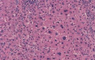 A nagysejtes dysplasticus focusok (large-cell dysplastic foci, LCDF) szövettani képe általában ijesztôbb.
