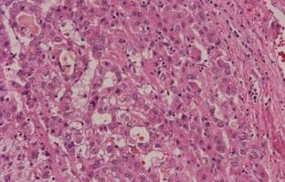 6. ábra. Magas kockázatú dysplasticus nodulus (HGDN). A képen a nodulus széli része látszik, nyilvánvaló citológiai és szerkezeti atípia jeleivel, a hepatociták néhol glanduláris elrendezôdésûek. 7.