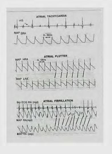 Reguláris pitvari tachycardiák Fokális: Ritmukusan