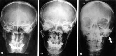 11. ábra: Röntgenkép: dislocalt collumtörés 12. ábra: Röntgenkép: posztoperatív felvétel: repozíció, ágaslemezes rögzítés, dentalis sín = normocclusio EREDMÉNYEK 13.