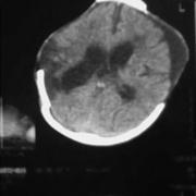 beavatkozás /haematoma eltávolítás, impresszió kiemelés, dekompresszió/ intracraniális