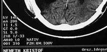 osszifikáció hydrocephalus internus alultápláltság rachea-kanül eltávolítása csak