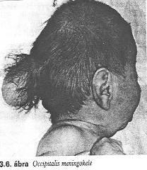 dysmyelinisatio A fejlődési rendellenességek részletes leírása Velőcső záródási rendellenességek anencephalia, encephalocele, meningocele.
