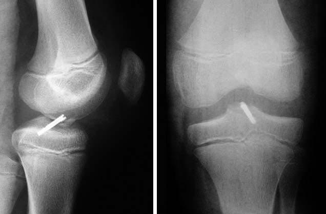 típusú tibia eminentia anterior törést. Az átlagéletkor 12,5 év (8 15) volt (5 8. ábrák). Négy fiú és egy lány volt a sérültek közt. I.