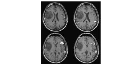 kapcsolatos adatok. Az agy működésével összefüggő neuronális aktivitást kimutathatjuk, és pontosan lokalizálhatjuk. Ezt a feladatot az ún. funkcionális MR (fmri) látja el.