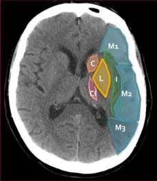 CT vizsgálat a korai ishamiás jelek kimutatásával alkalmas a stroke diagnózisának megerősítésére.