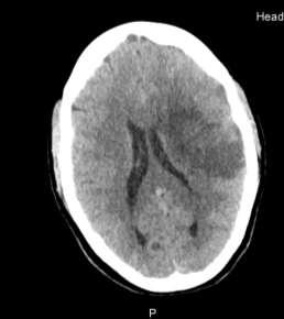 9.Esetismertetés A következőkben egy beteg kórtörténetén keresztül szeretném bemutatni az ischaemias stroke kivizsgálásának gyakorlatát a beérkezéstől, a terápián át a páciens elbocsátásáig.
