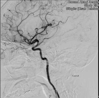 2.kép DSA képek a betegről a thromboectomia előtt és után ((A képanyag a B.-A.-Z.