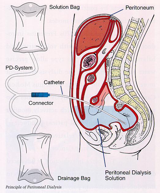 Peritonealis dialysis