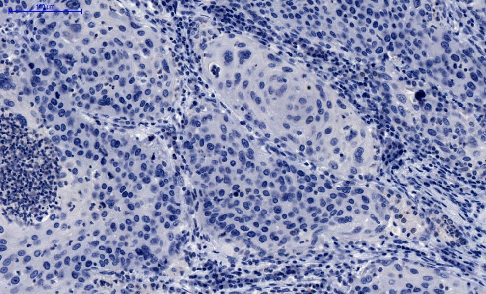 A WHO 2004- ben kiadott osztályozása alapján a tüdődaganat az AC csoportba sorolható, ha az epitél eredetű tumor mucint termel és acináris, papilláris, bronchoalveoláris vagy szolid