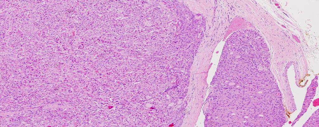 1.1.3.2 Follicularis carcinoma Az az összes pajzsmirigydaganat körülbelül 12-15%-a. Ez a carcinoma az idősebb betegek, főleg nők esetében alakul ki.