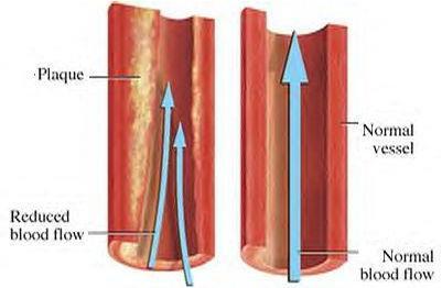 Vasospasmus II. C/ Fizikai 1. Catheter indukált 2. PTCA (PCI) 3. Laser (különösen NdYAG és Argon) 4. Atherectomia 5.