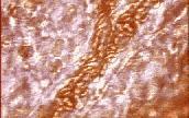 kapillárisai (3-5 μm), így a rheologiai eltérések a myocardium