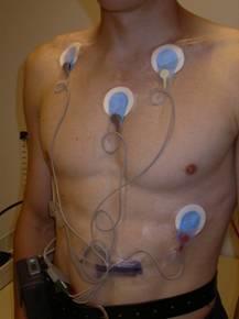 DIAGNOSZTIKA - EKG (hosszabb futtatás): gyakran nem diagnosztikus - Holter monitorozás: 24 vagy időnként 48 óra -