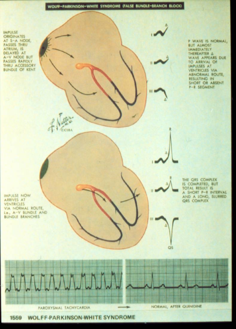 AV reciprok tachycardia