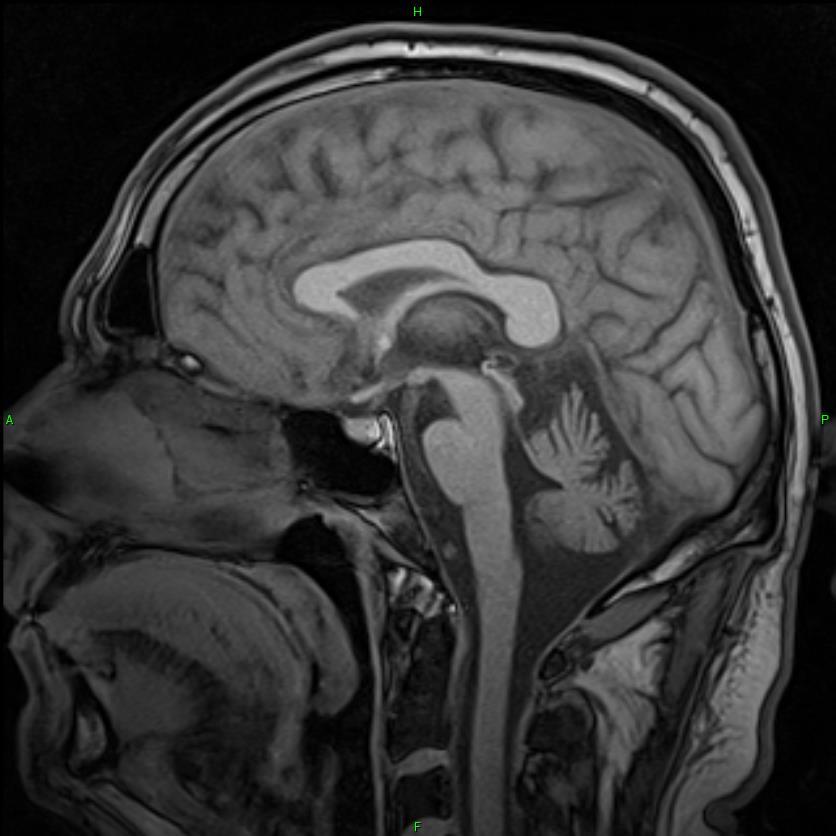 Parkinson-plus syndroma MSA - C,