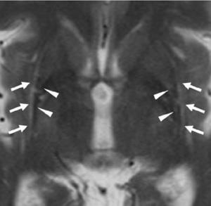 Parkinson-plus syndroma: MSA - P, a putamen volumene csökken,