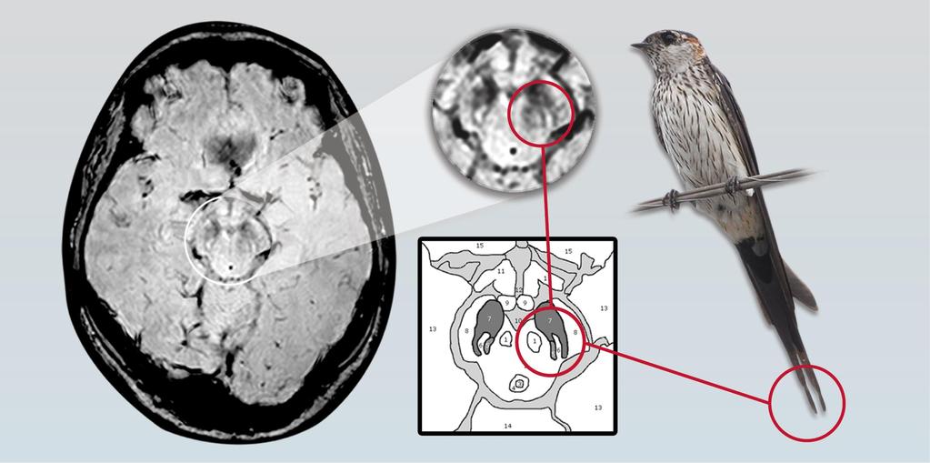 Parkinson kórban a substantia nigra MR megjelenése megváltozik.