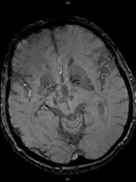 sign) a mesencephalonban a substantia