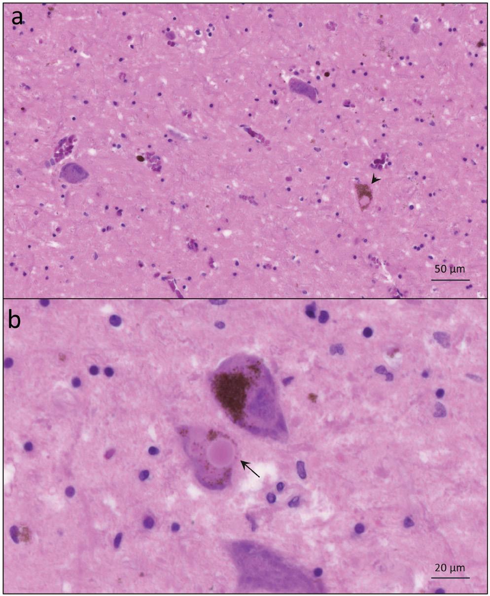 1. ábra Mesencephalon, substantia nigra. a) Súlyos neuronvesztés. Lewy-test az egyik neuronban (nyílhegy).