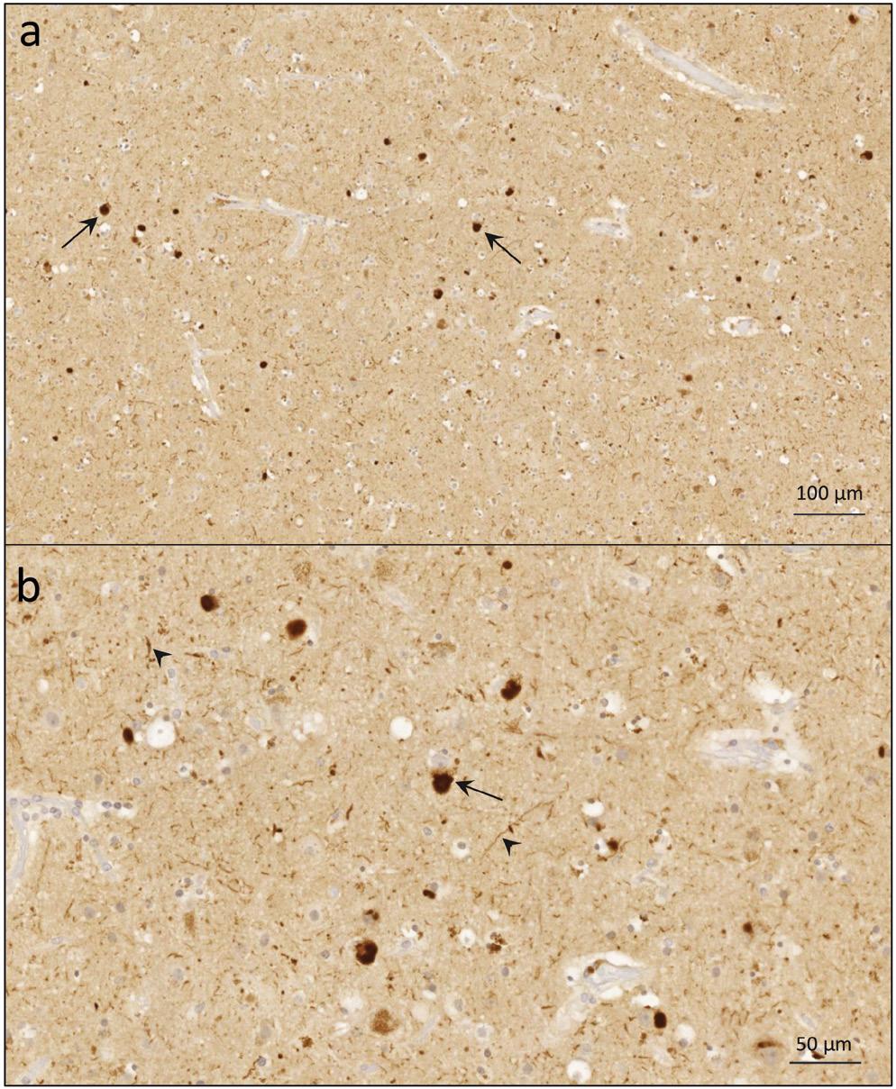 ábra Frontalis lebeny, neocortex. a) Kis nagyítással súlyos neuronvesztés, α-szinuklein-pozitív intraneuronalis inklúziók (Lewytestek) (nyilak).