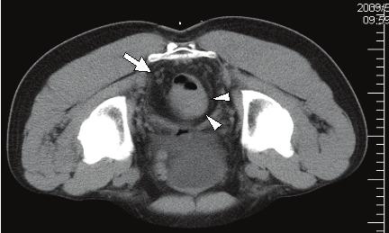 RÁPOLTI ÉS MTSAI BEVEZETÉS A rectumcarcinoma (RC) mind a férfiak, mind a nők körében az egyik leggyakoribb rosszindulatú daganatos megbetegedés.