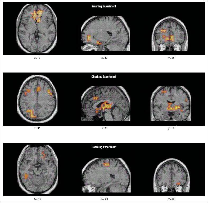 fmri tünetprovokáció alatt (16 OCD; 17 Normál) (Mataix-Cols 2004) OCD dimenziók szerinti averzív